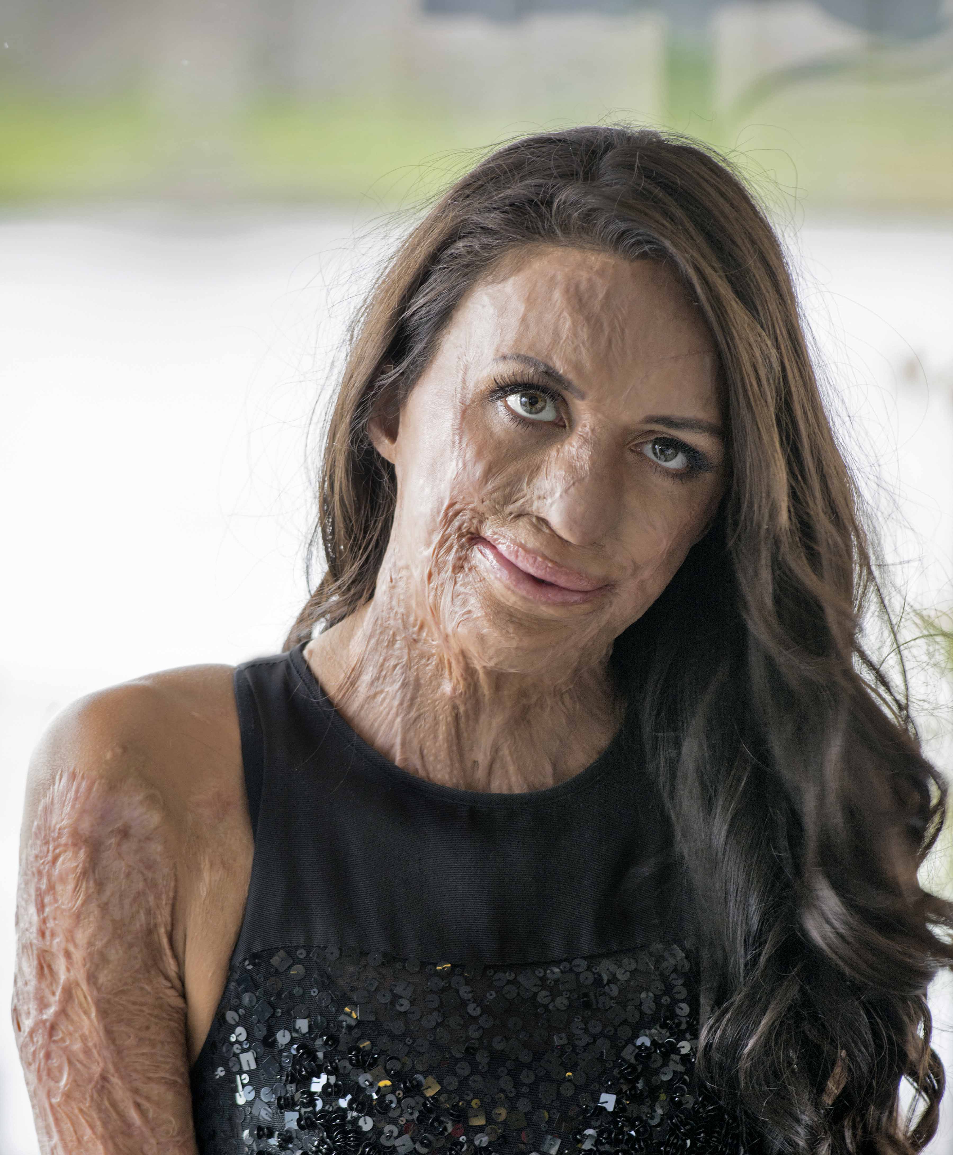 Turia Pitt Keynote Speakers Bureau and Speaking Fees